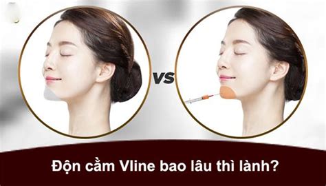 Độn cằm V Line là gì Độn cằm có đau và nguy hiểm không