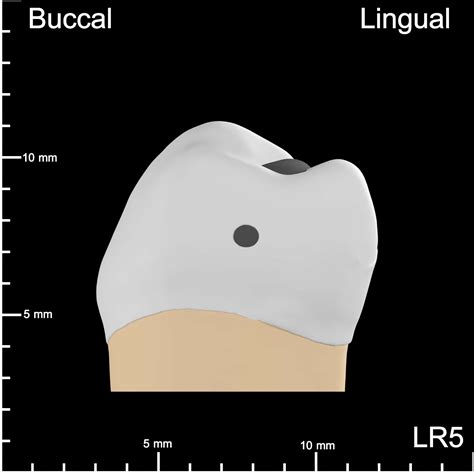 LR5 Mesial and Occlusal Decay – 10K Teeth