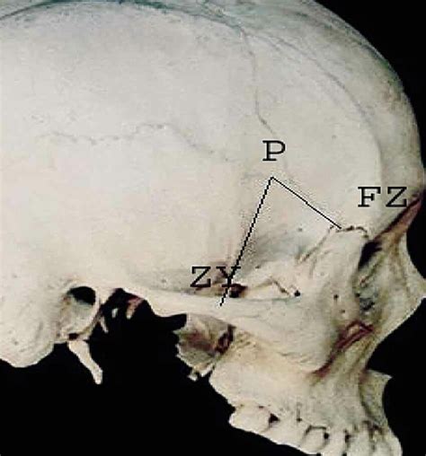 Dimensions taken for location of the pterion. P=Center of pterion,... | Download Scientific Diagram