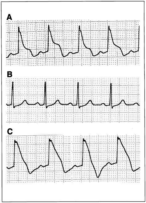 St‐segment Elevation And Qrs Widening Occurred About 1 Min After Download Scientific Diagram