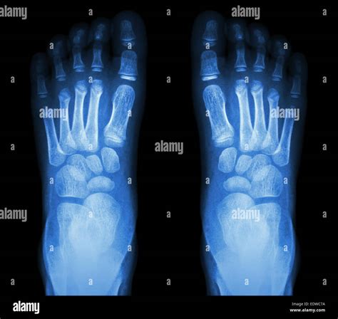 X-ray normal child's foots Stock Photo - Alamy