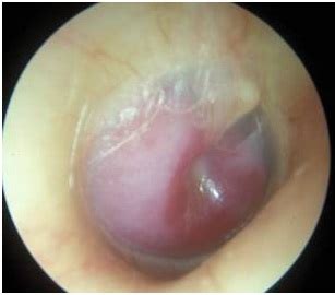 Tumori Glomici O Paraganglioma TimpanogiuguIare O Chemodectoma