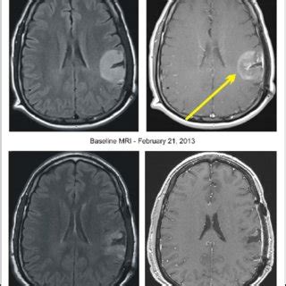 Proposed mechanism of action of PB, pazopanib, and additional targeted ...