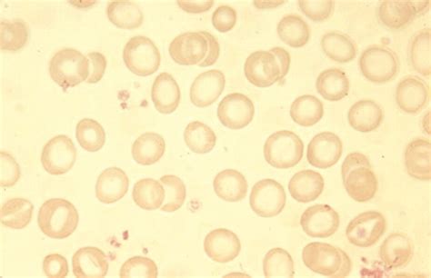 Microcytic Hypochromic Anemia blood smear and CBC Reports | Medical Laboratories