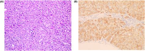 Pathological Map And Immunohistochemical Map Of Primary Liver Cancer Download Scientific