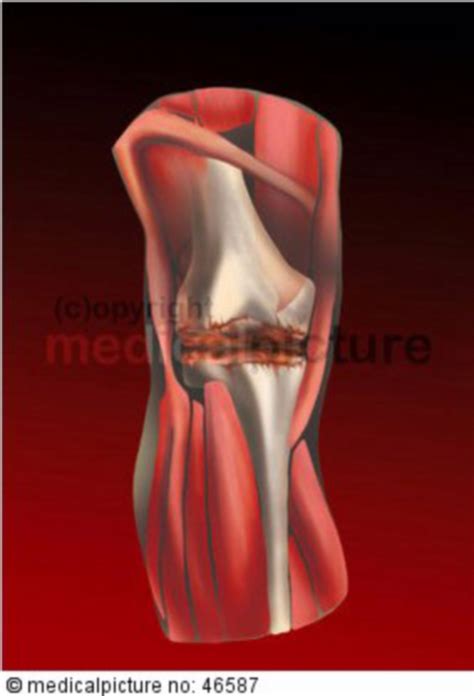 Arthritis, knee - DocCheck