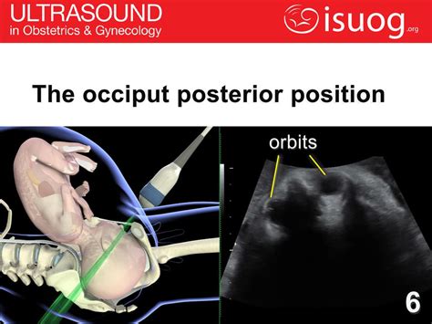 How To Perform Ultrasound In Labor The Fetal Occiput Position Ppt