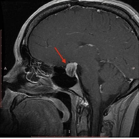 MRI of pituitary fossa compressing the optic chiasm | Download ...