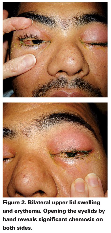 Swollen Lacrimal Gland