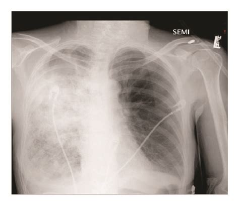 Baseline (a), during pseudomonas pneumonia (b), and follow-up (c) chest ...