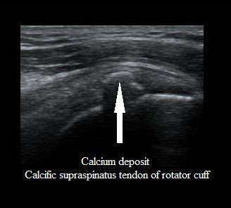 Shoulder Ultrasound