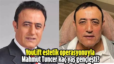 Youlift Estetik Operasyonuyla Mahmut Tuncer Ka Ya Gen Le Ti H Rs Z