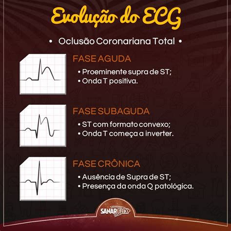 Interpretar Ecg Como Se Preparar Sanarmed