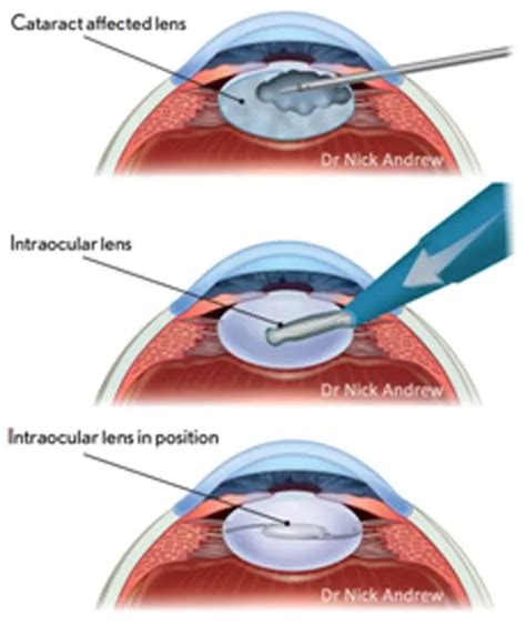 Posterior Capsule Opacification Sight Specialists Gold Coast