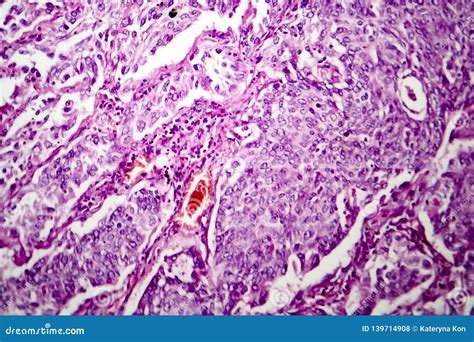 Lung Adenocarcinoma Light Micrograph Stock Illustration Illustration