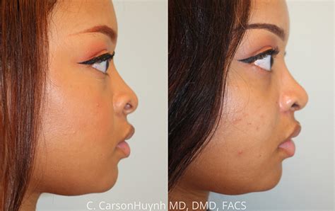 African American Rhinoplasty Case 3189 Radiance Surgery Aesthetic