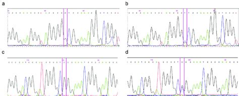 TERT C228T And C250T Promoter Mutations In GB A 146th Base Wild Type