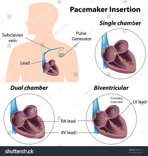 Pacemaker Insertion Surgery Stock Illustration 90181147 | Shutterstock