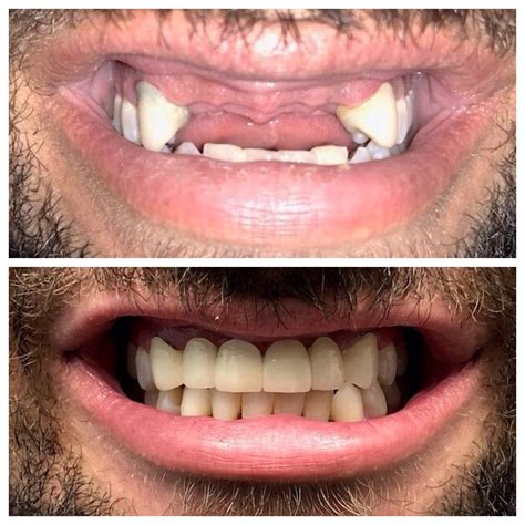 Top 97 Pictures Pictures Of Front Teeth Crowns Superb