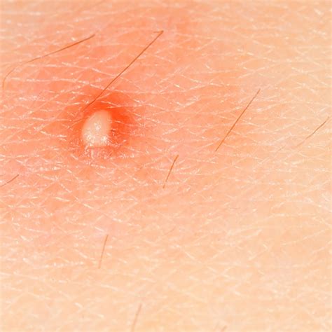 Lesions On Bikini Line At Dylan Schmella Blog