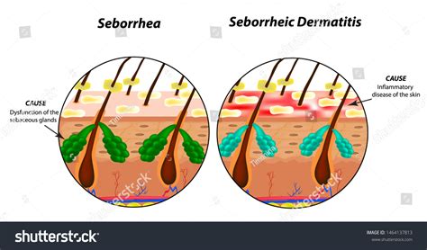 Causes Seborrhea Skin Hair Dandruff Seborrheic Stock Illustration ...