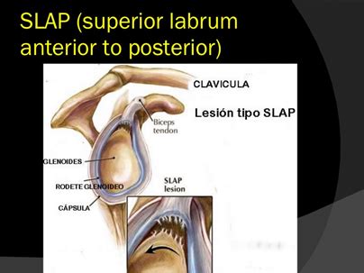 LESIÓN LABRUM DE HOMBRO