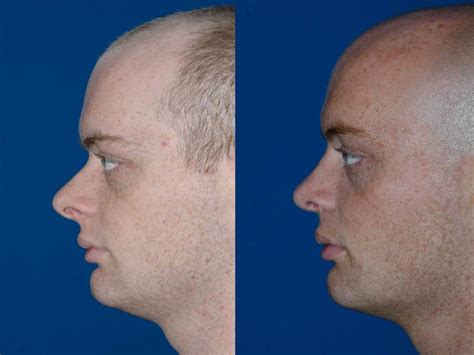 Seattle Rhinoplasty Expert | Top Rated Bellevue Rhinoplasty Surgeon