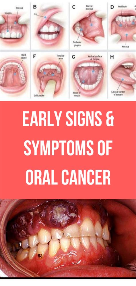 Early Signs & Symptoms of Oral Cancer | Wellness Rise