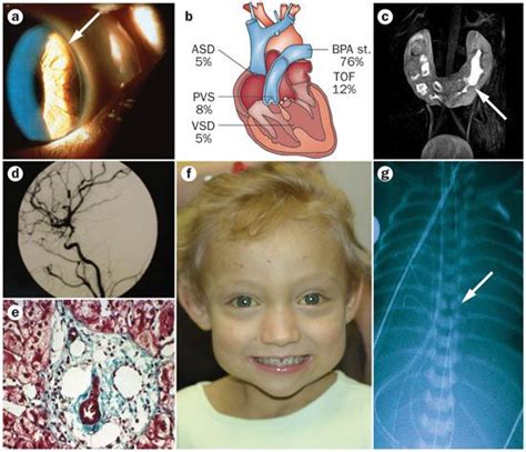 Alagille Syndrome Jag 1 20p12 Mutation Or Del 5