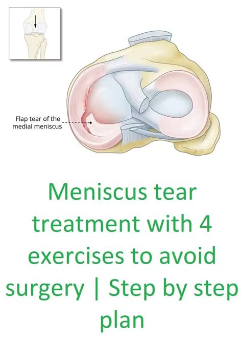 Meniscus Tear Cause Symptoms And Treatment With Exercises Artofit