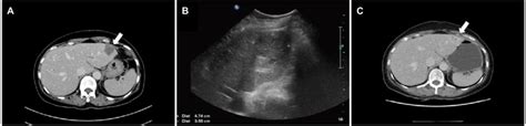 A In Case 2 The Initial Abdominal Computed Tomography Ct Showed A