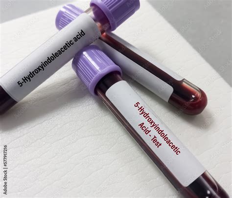 Blood sample for 5-HIAA (5-Hydroxyindoleacetic acid) test, used to help ...