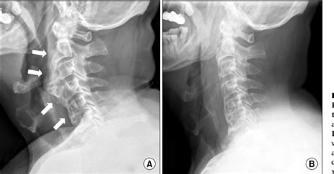 Figure 1 From Early Detection Of Anterior Cervical Osteophytes Causing Dysphagia By