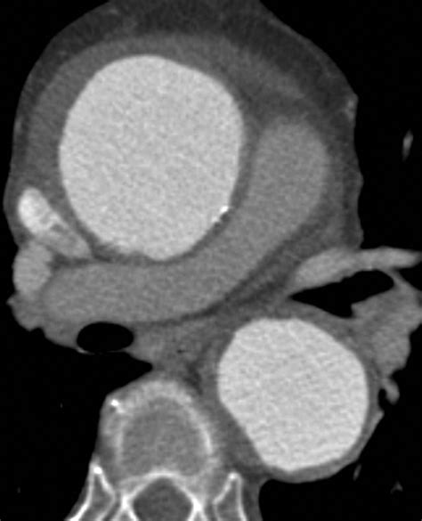 Natural History And CT Appearances Of Aortic Intramural Hematoma