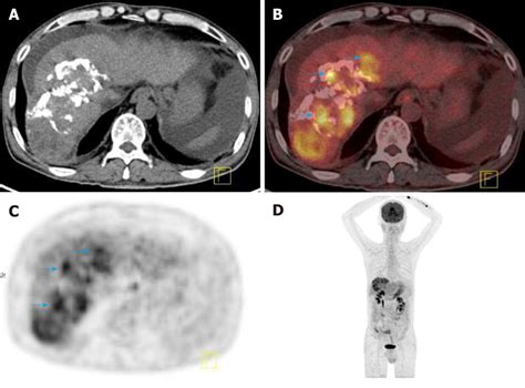 Deoxy F Fluoro D Glucose Positron Emission Tomography Computed