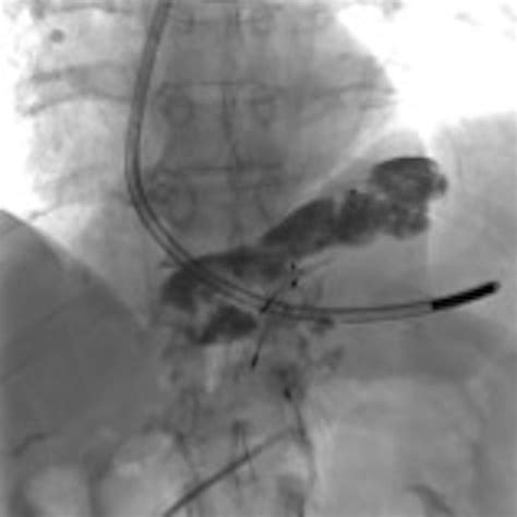 Atypical Use Of Aln Inferior Vena Cava Filters As Protection Devices