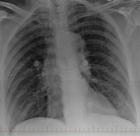 Ap Chest Radiograph On Admission Arrow Indicates Intimal Calcification Download Scientific