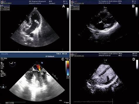 Ultrasound Of The Cardiac Tumor A Two Chamber View In Transthoracic