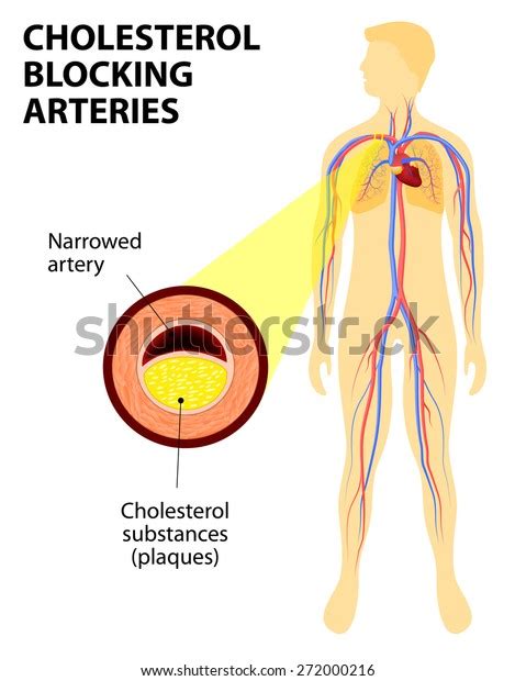 Vektor Stok Anatomy Heart Attack Diagram Myocardial Infarction Tanpa