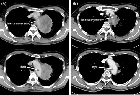 Chest Computed Tomography Demonstrated A Tumour In The Left Upper Lobe