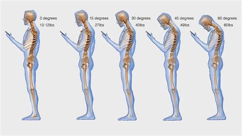 Text Neck Syndrome - Signs Symptoms and Solutions