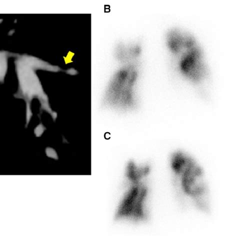 Chest Computed Tomography And Perfusion Scintigraphy Of The Lung A