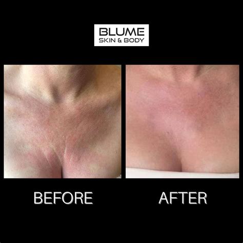 Laser And Skin Treatments Before And After Photos Scottsdale Arizona