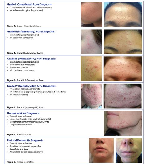 A Physician's Guide to Treating Acne