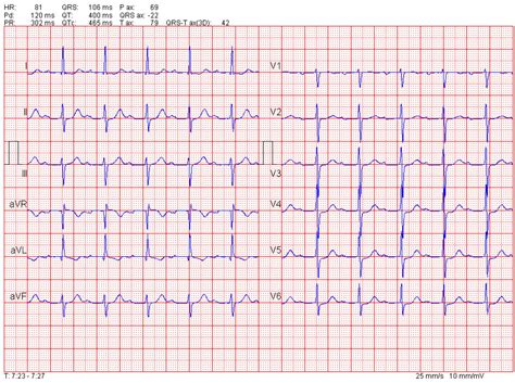 Paroxysmal Atrial Tachycardia With Block