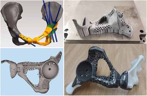 Three Dimensional Printed Implant For Reconstruction Of Pelvic Bone After Removal Of Giant