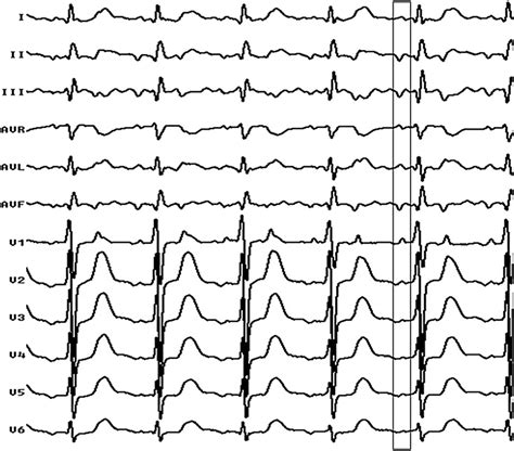 e Twelve lead surface electrocardiogram of showing positive " P " waves ...