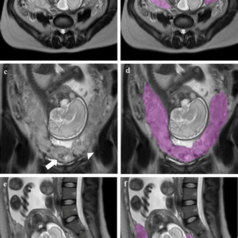 A 29 Year Old Woman With Suspected Placenta Accreta Spectrum Pas Download Scientific Diagram