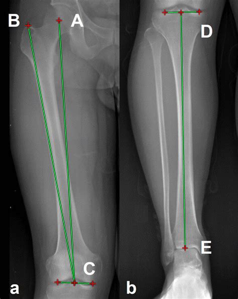 Measurement Of Lower Limb Length Ratio A The Femoral Length Was