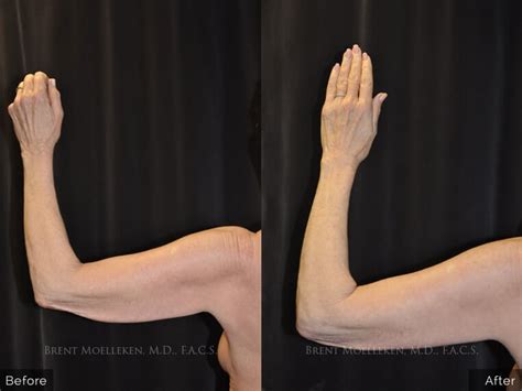 Before And After Brachio Plasty Photo Gallery Brent Moelleken M D